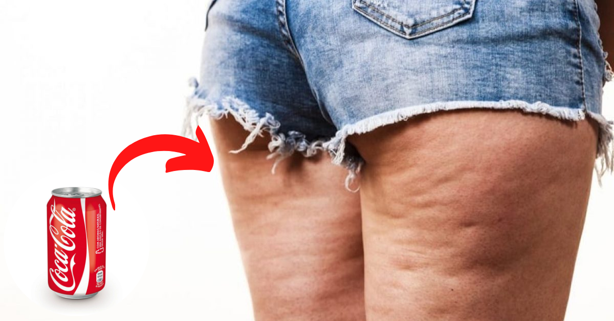 Gás do refrigerante provoca celulite: verdade ou mentira?