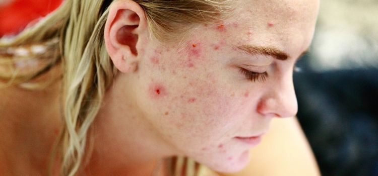 chocolate dá espinha é mito ou verdade