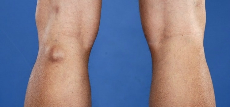 cisto de baker sintomas