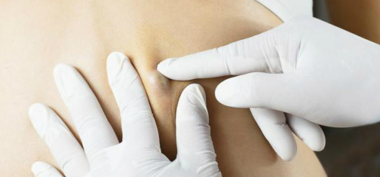 cisto sebáceo inflamado