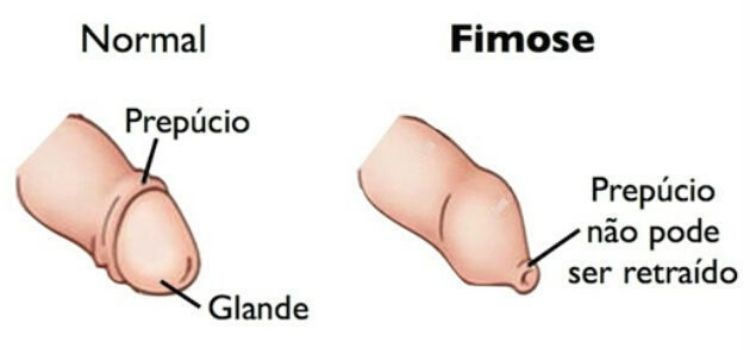 Fimose urosrn urologistas em Natal