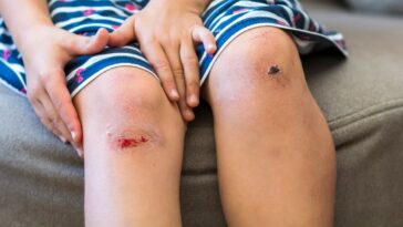 como estancar sangramentos