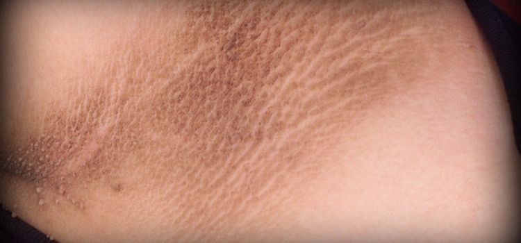 formas de como tirar manchas no pescoço