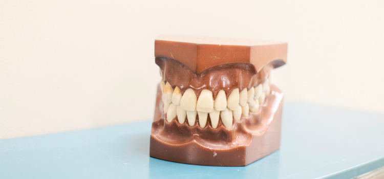 como tirar tártaro dos dentes