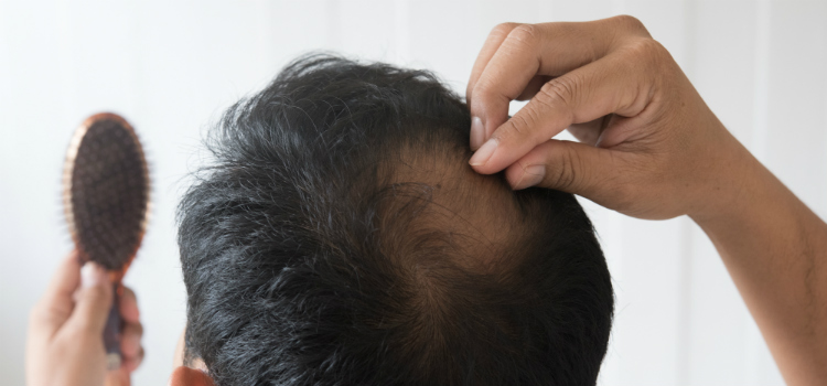 cura da calvice tratamentos