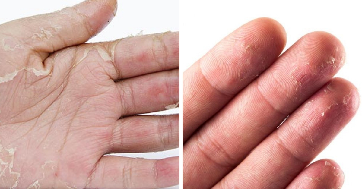 Dedos descascando o que pode ser?