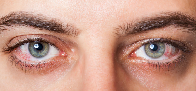 derrames oculares por que acontecem