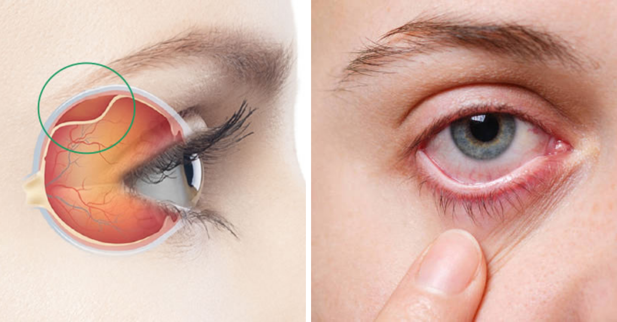 Descolamento de retina possíveis causas, sintomas