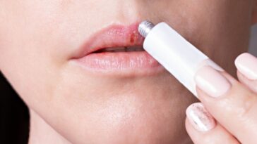 dicas de como tratar herpes labial