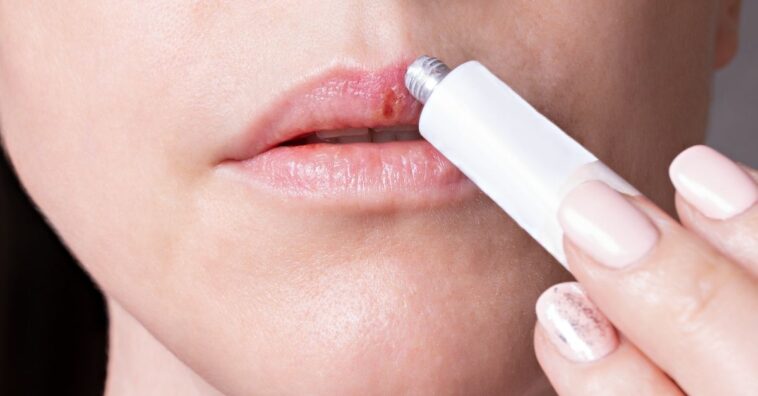 dicas de como tratar herpes labial