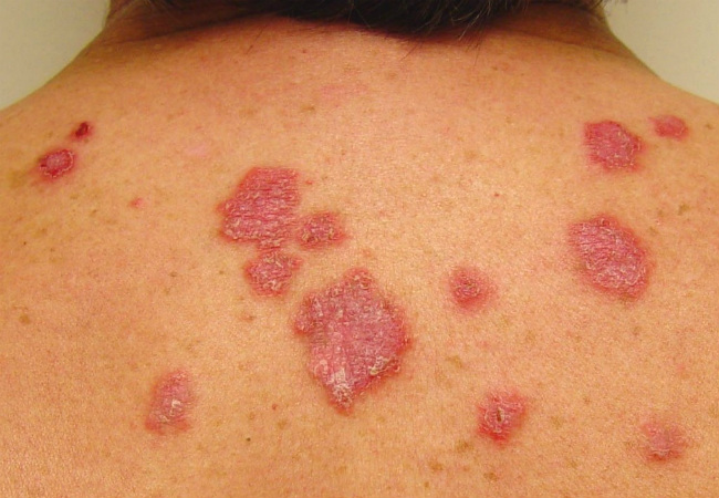 doenças autoimunes lupus