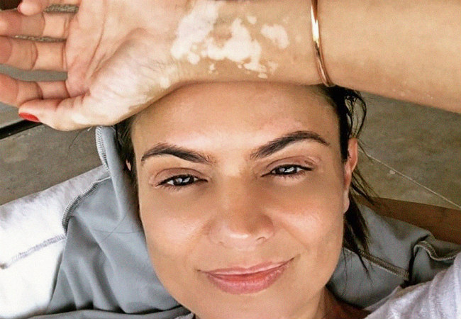 doenças autoimunes vitiligo