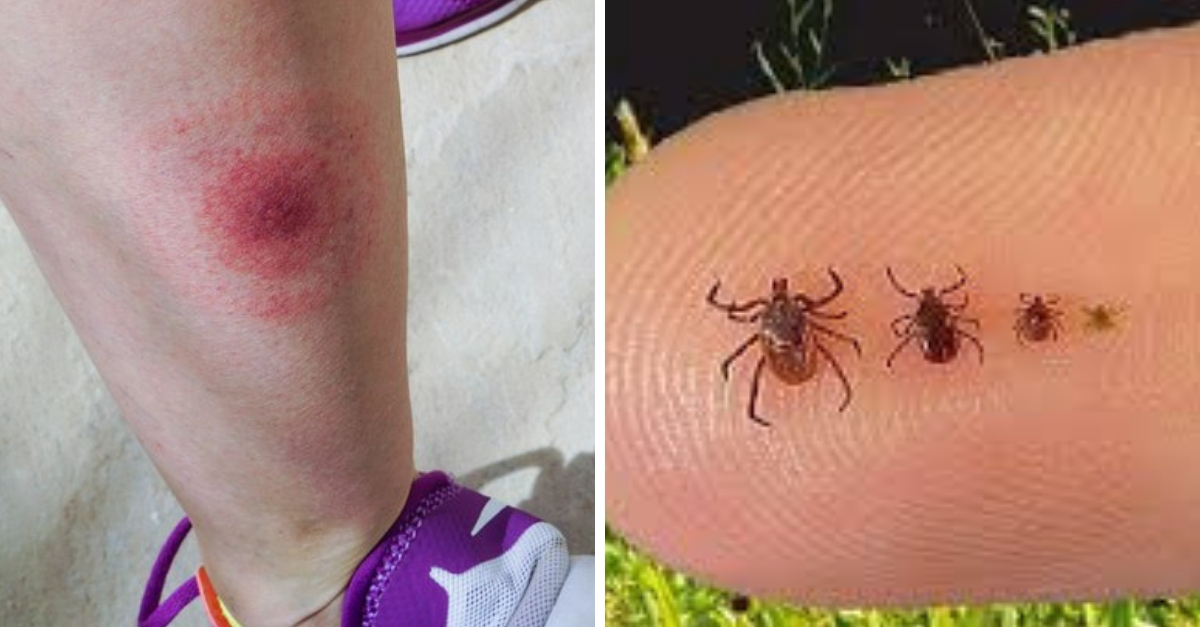 Doença de Lyme o que é, sintomas e tratamento