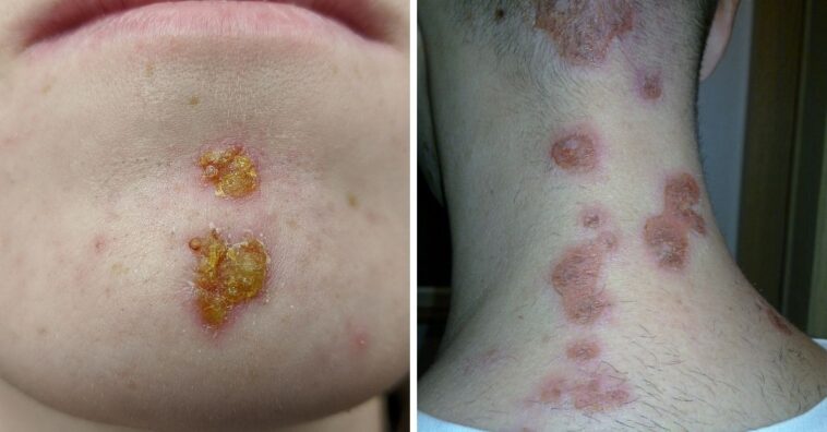 impetigo tratamentos