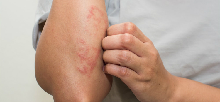 tratamento caseiro para eczema