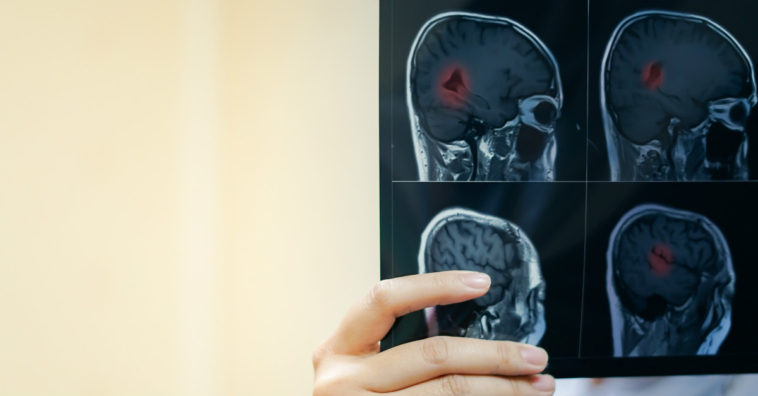 epilepsia o que é tipos e causas