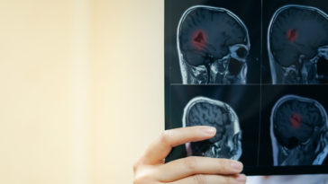 epilepsia o que é tipos e causas