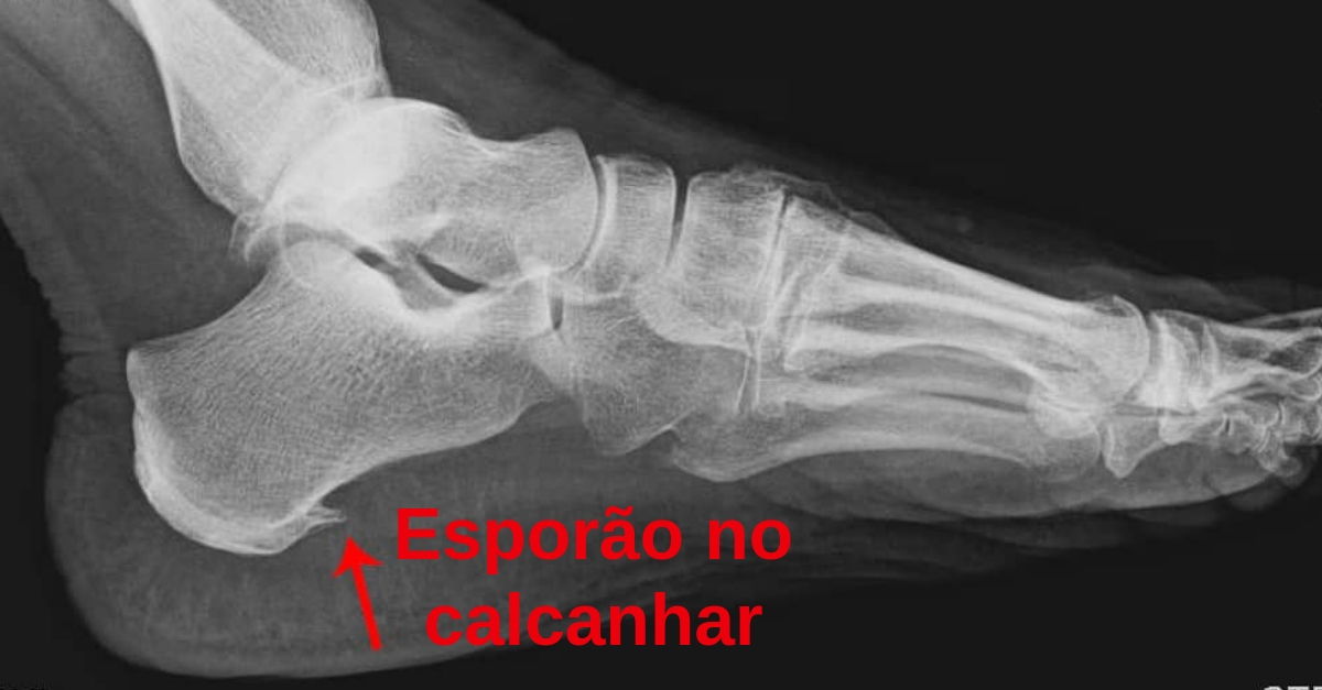 Esporão no calcanhar: o que é, sintomas e tratamentos