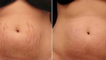 acabe com as estrias