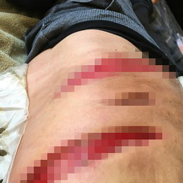 ex-vegana muda radicalmente de dieta fasciíte necrosante