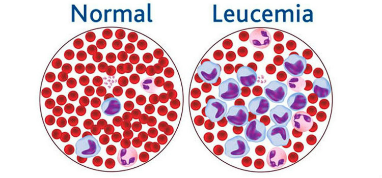 exame leucemia