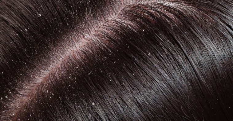 falsa caspa o que fazer