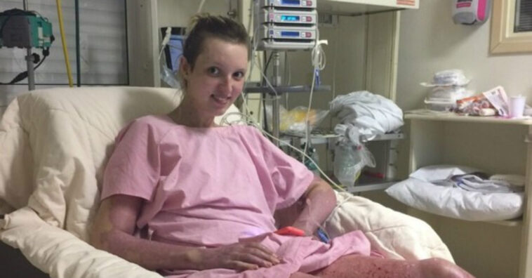 forno explode e queima jovem