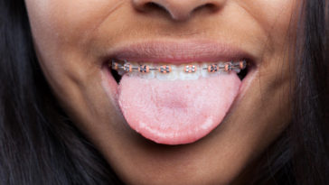 gosto metálico na boca como evitar