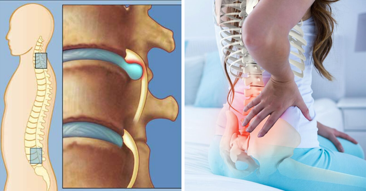 O que é a hérnia de disco e como tratá-la