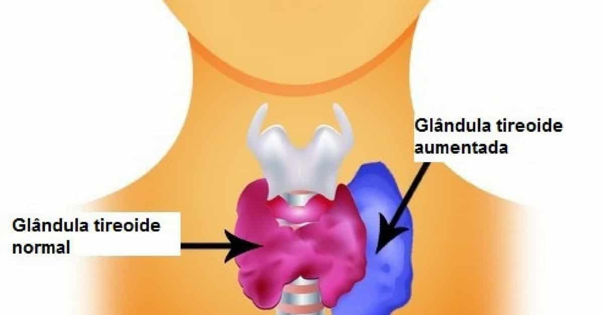 O que é hipertireoidismo, os sintomas e tratamentos