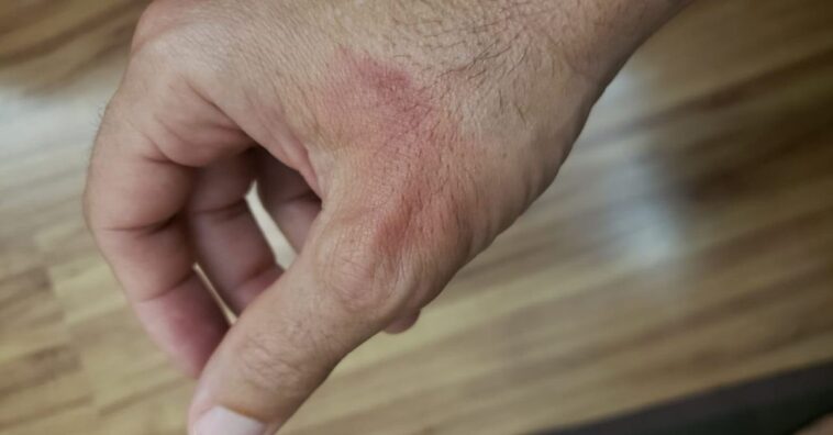 homem queima a mão ao usar álcool em gel