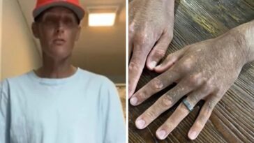 escurecimento da pele