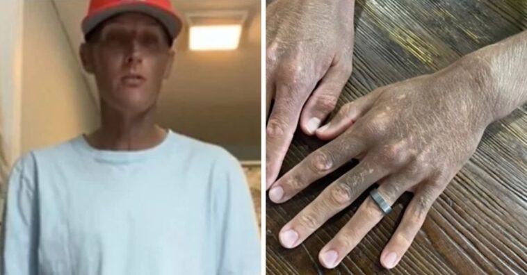 escurecimento da pele