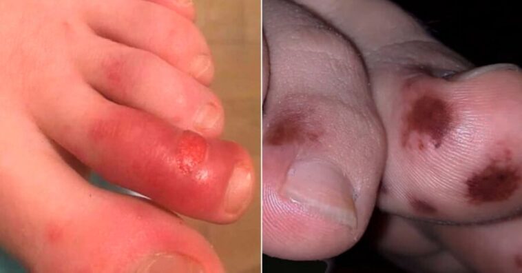 lesões nos dedos podem ser sintoma de covid