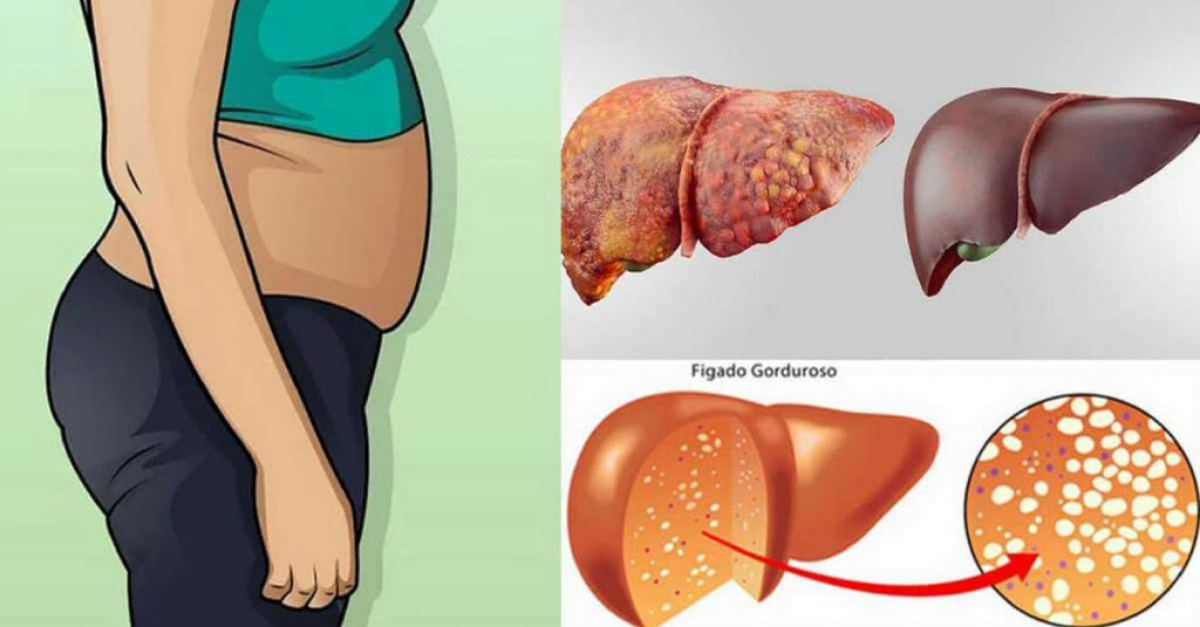 Livre Seu Fígado De Gorduras Com Essa Receita
