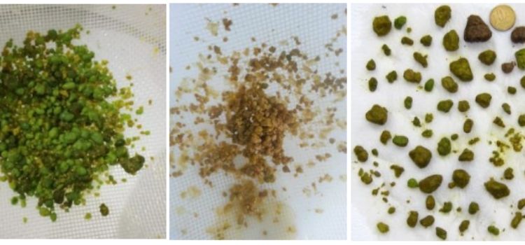 limpeza do fígado pedras eliminadas