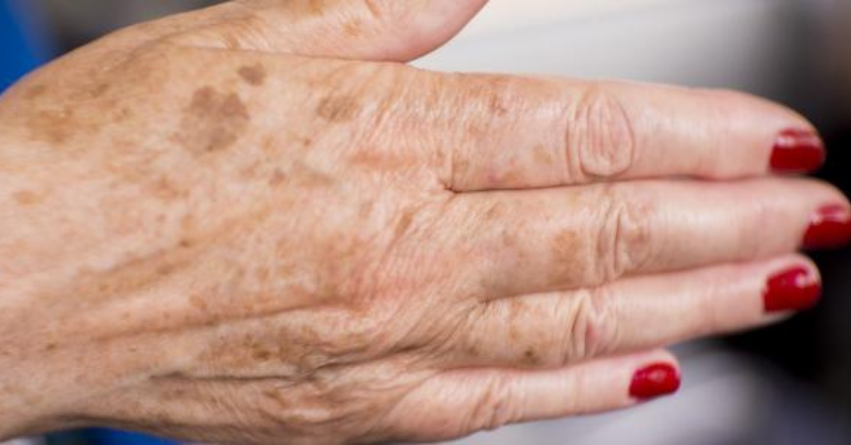 Como atenuar manchas da idade nas mãos?