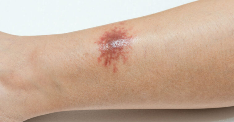 manchas escuras na perna