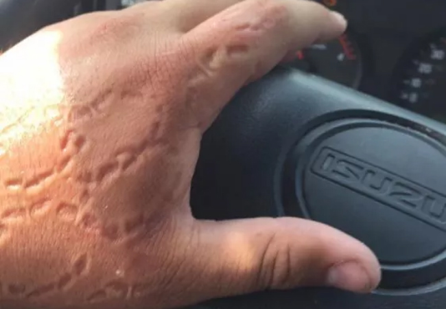 manifestações físicas de ansiedade morder a mão