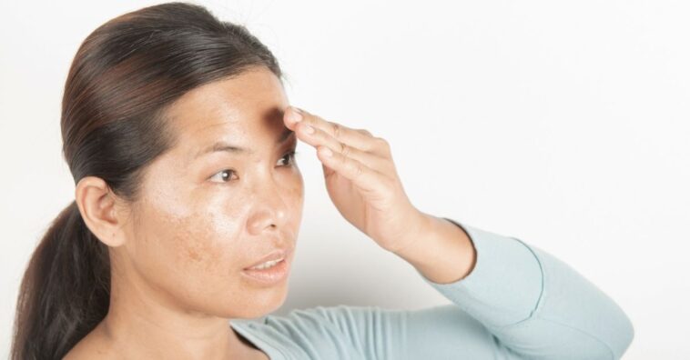 melasma piora com água quente