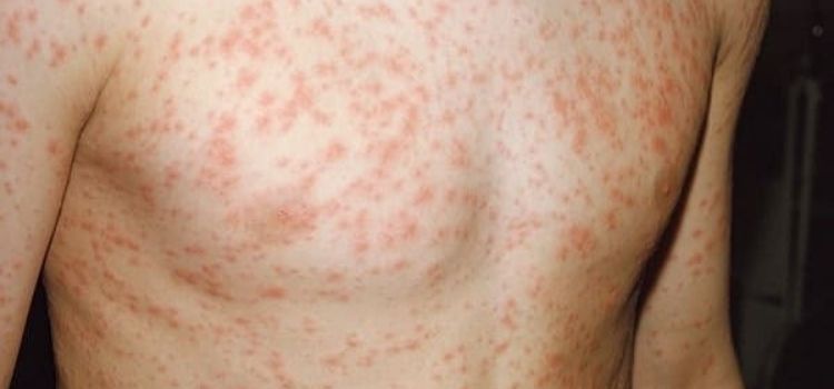 os melhores remédios caseiros para escarlatina