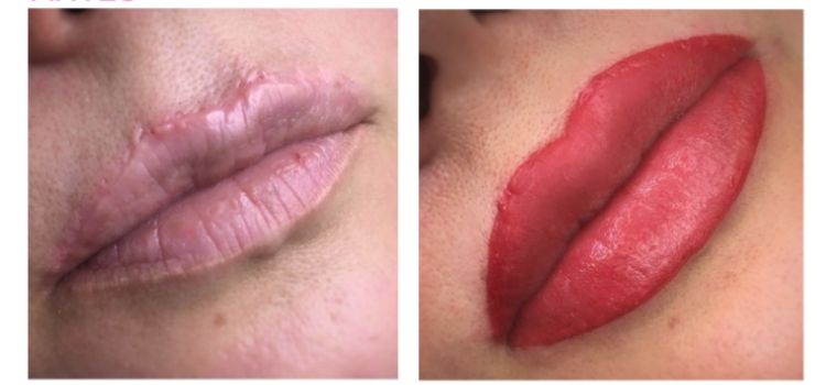 micropigmentação labial com cicatriz