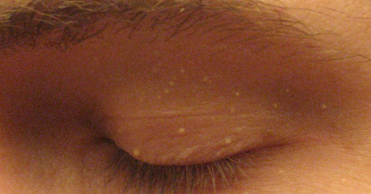 milium o que é e como tirar