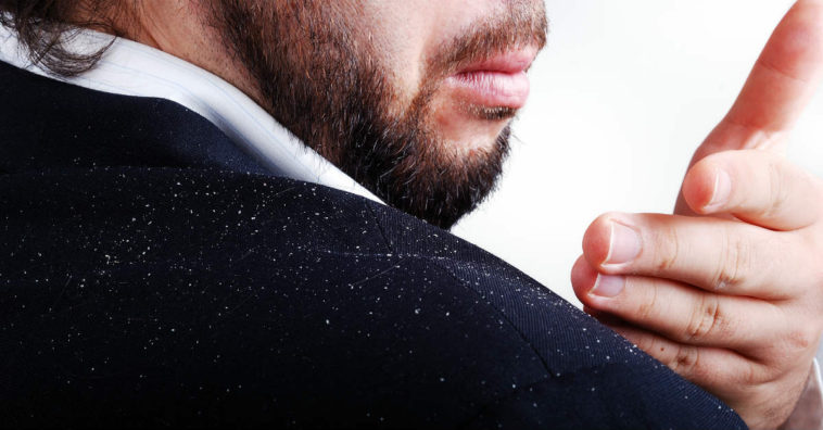 mitos e verdades sobre a caspa