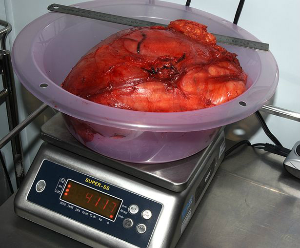 mulher ignora nódulo e ele cresce