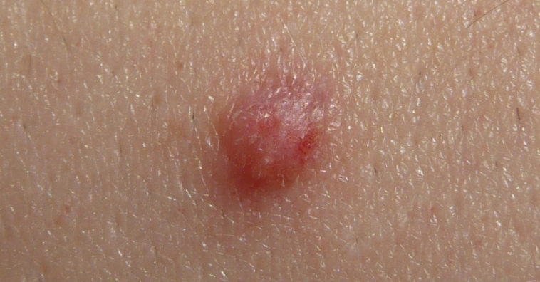 o que causa verrugas