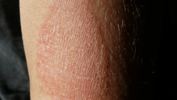 o que é um eczema e como tratar