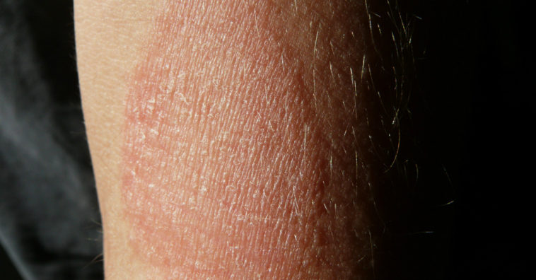 o que é um eczema e como tratar