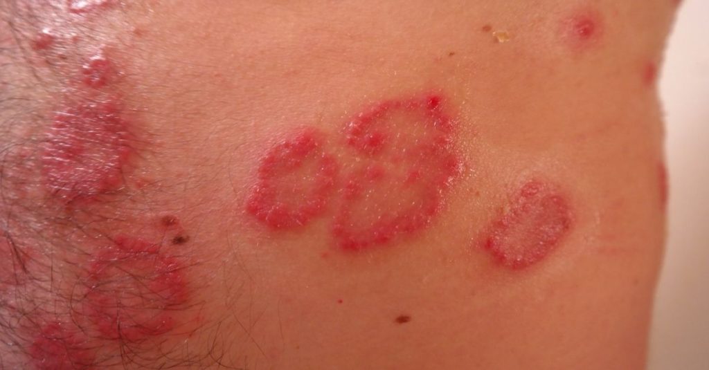 7 Doenças que causam manchas vermelhas na pele