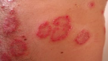 manchas vermelhas na pele